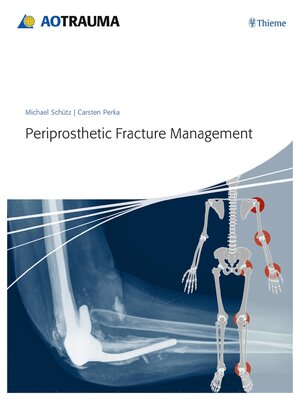 cover image of Periprosthetic Fracture Management